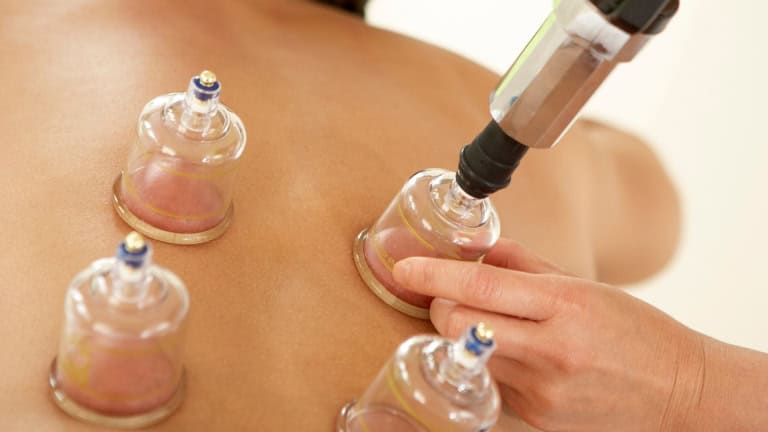 a person getting a cupping treatment